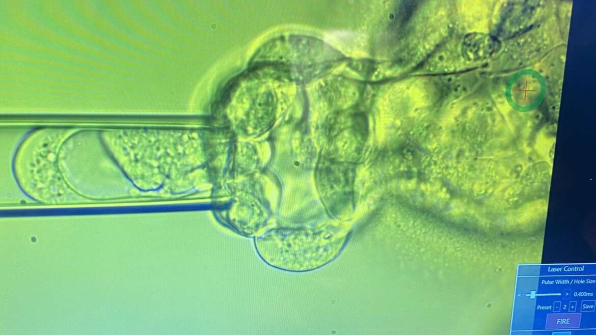 Подходит ли Вам ПГТ и биопсия эмбриона? - Next Fertility Nordic